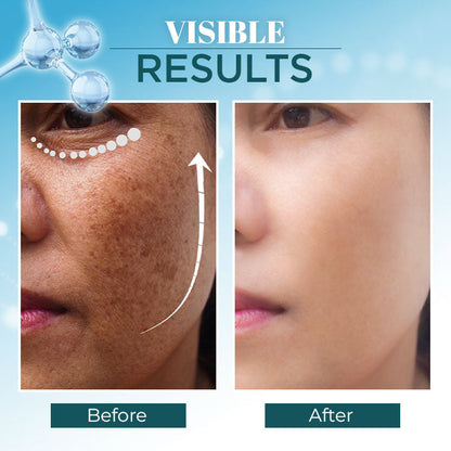 Lanthome™ Dark Spot Corrector Remover